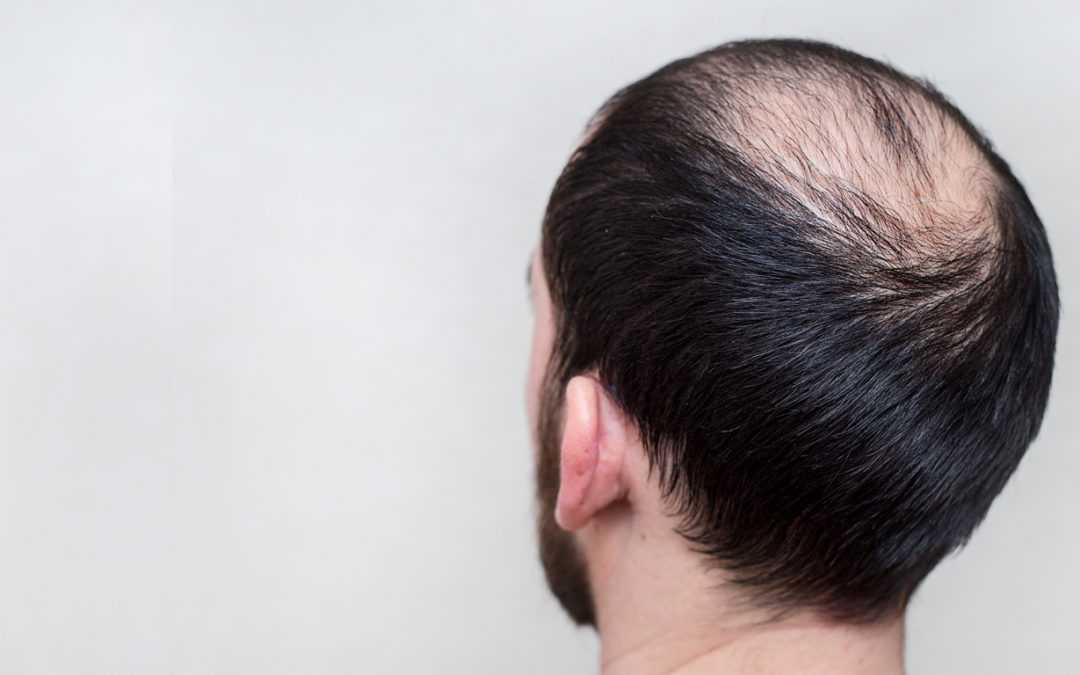 К чему снятся волосы во рту. Залысина на затылке у женщин. Выпадение волос абстракция. Comparison of alopecia Areata.