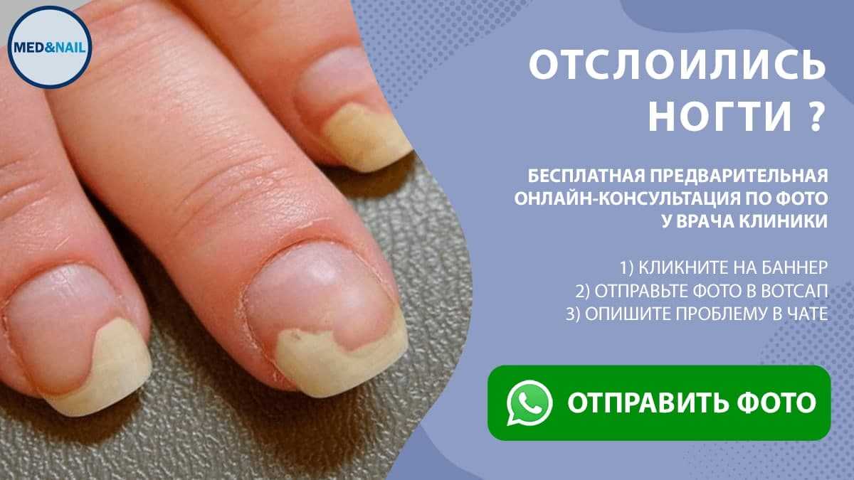 Белое пятно на ногте - примета (что означают белые точки на ногтях)