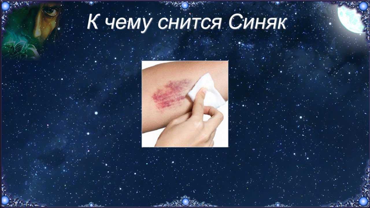 Что значат синяки во сне и как понять значение синяков, ссадин, кровоподтеков Что значит синяк под глазом, на шее, на лбу, на носу что делать, если вам снятся синяки на ногах