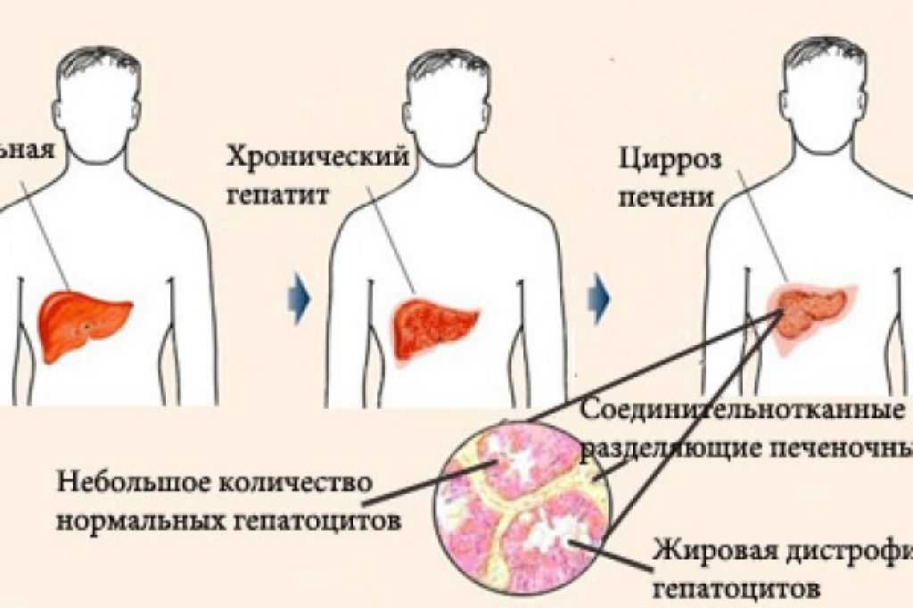 Симптомы цирроза у женщин. Человек больной циррозом печени. Признаки цирроза печени у мужчин. Цирроз печени симптомы у мужчин. Цирроз печени симптомы признаки у мужчин.