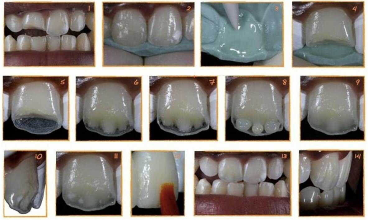 Зубная реставрация. Микропротезы виниры вкладки стоматология. Зубы клиновидный кариес. Восстановление передних зубов.