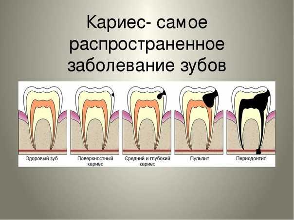 После какого поражения. Схема заболевания зубов. Стадии поражения зубов. Кариозные поражения зубов.