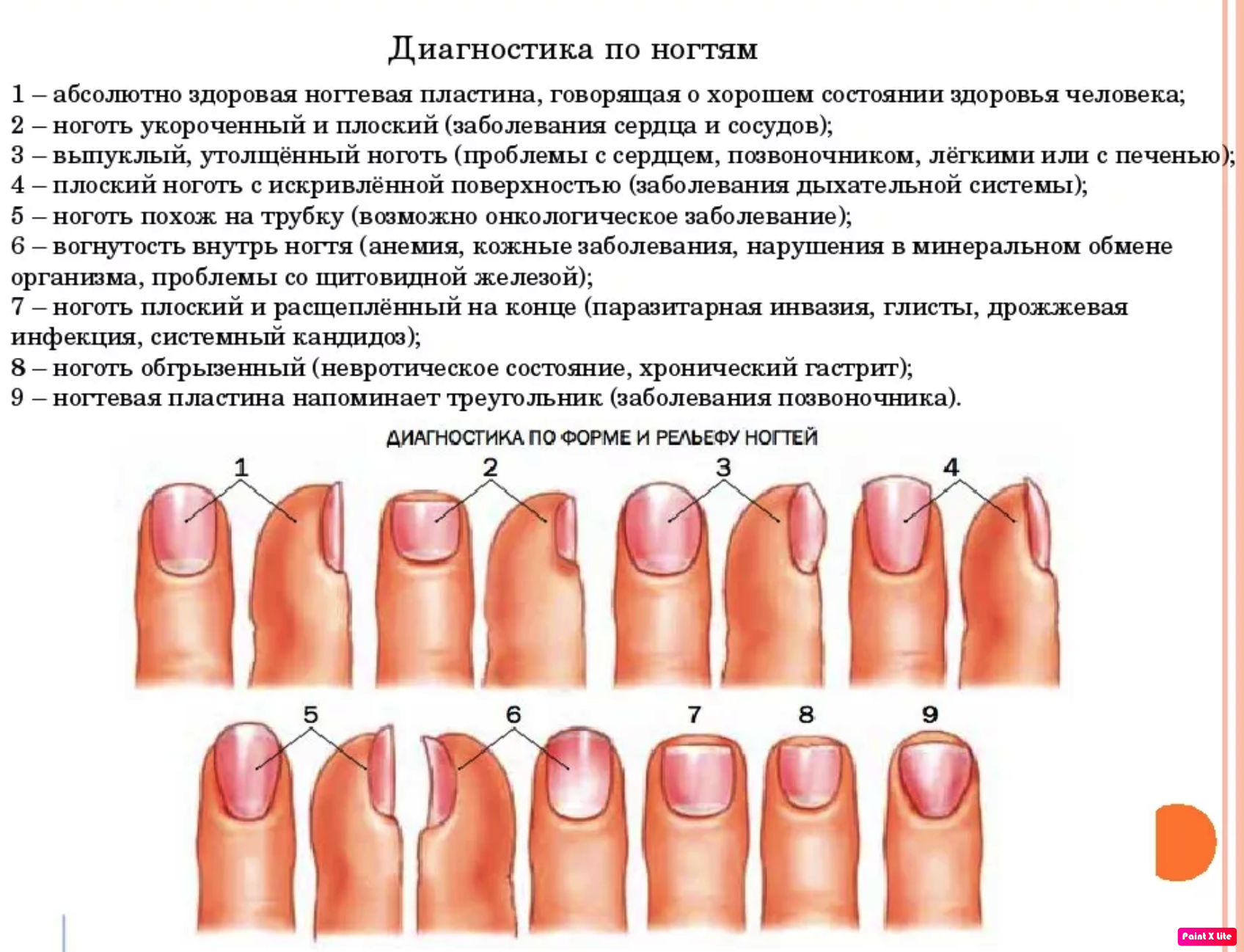 Определение болезни по состоянию ногтей
