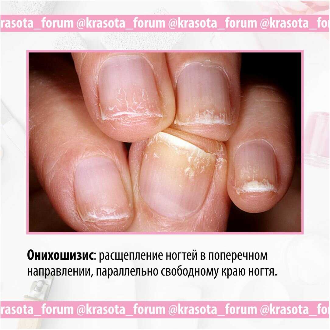 К чему сломался, чешется, отходит ноготь, белые пятна на ногтях, грибок ногтей: приметы и суеверия. когда стричь ногти по дням недели: приметы. почему нельзя грызть и красить ногти черным лаком: приме